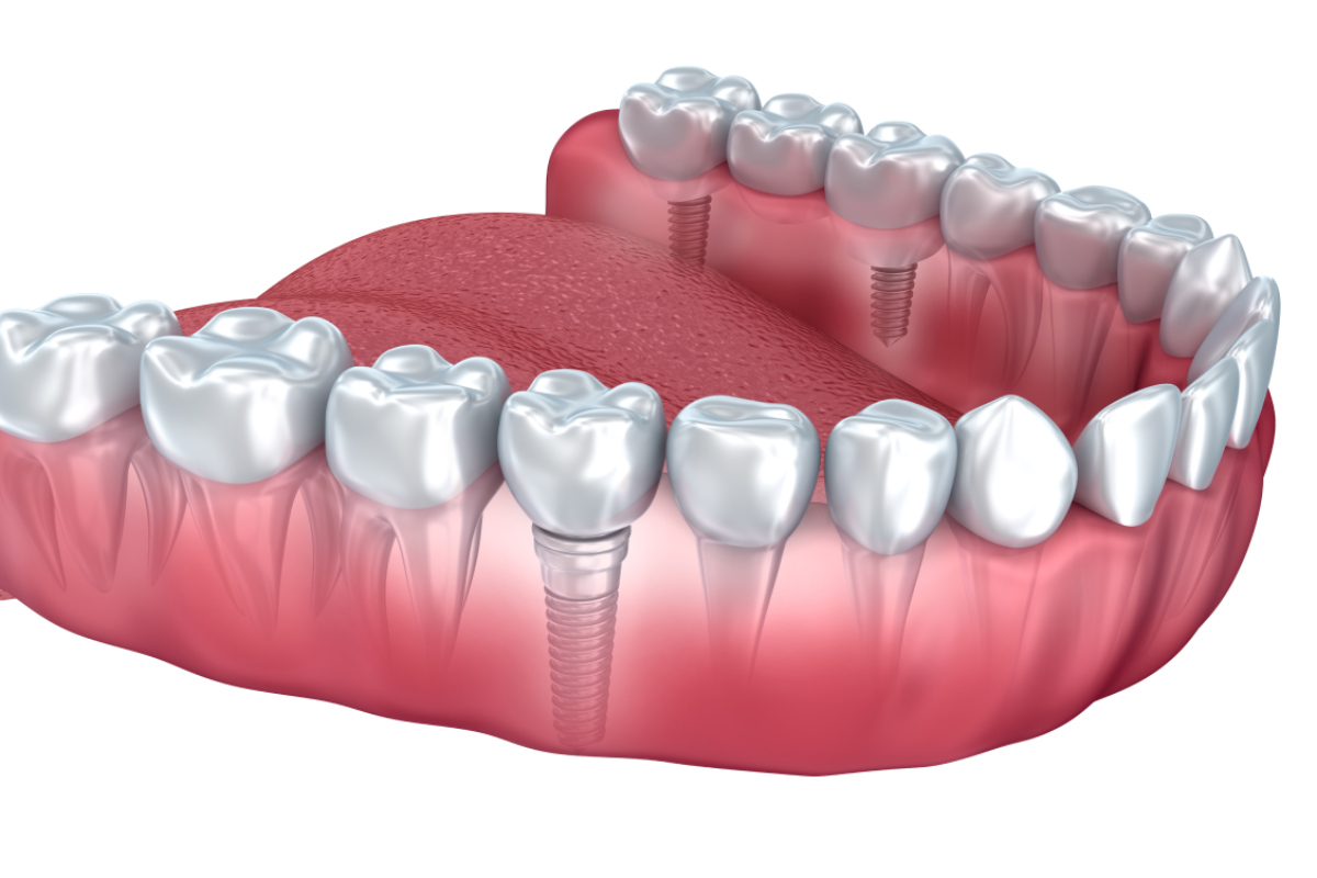 What Are Dental Implants?​