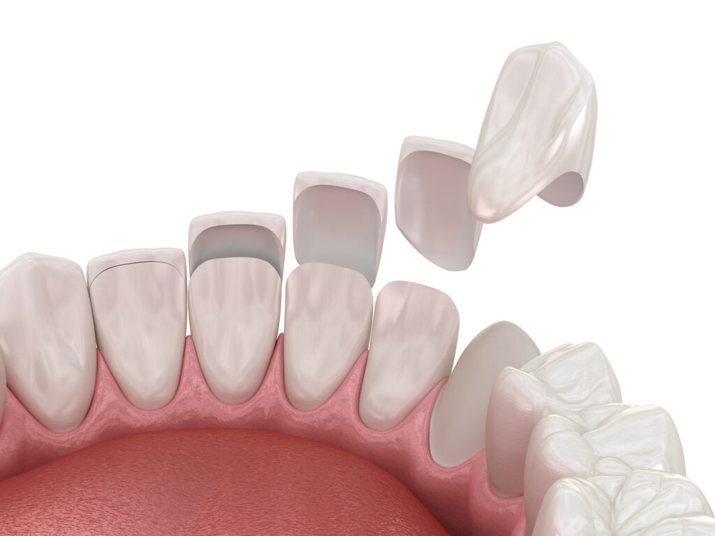 Dental veneer placement over frontal teeth. 3D illustration