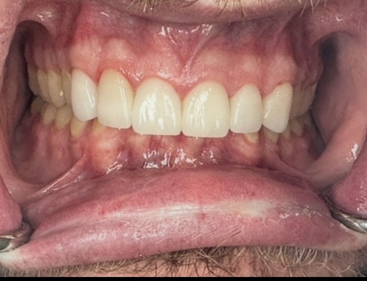 an image of a smile after restorative procedures