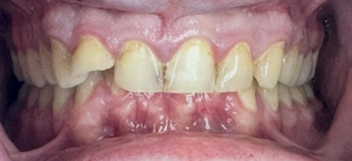 an image of a smile before restorative procedures