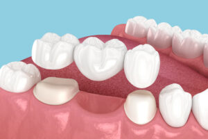 Educational model of dental bridge being placed