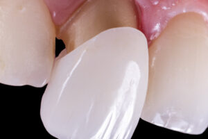 Dental tooth crown being placed