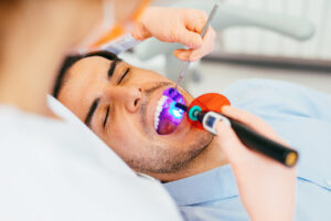 Man getting dental filling cured in dentist office