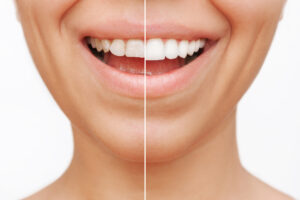 Female patient before and after dental veneers