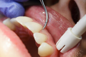 Patient receiving periodontal treatment in dentist office